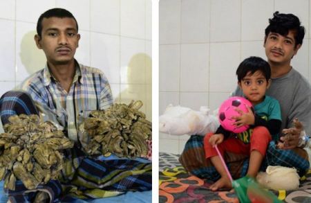 أخيراً ... ‘ الرجل الشجرة ‘ يحتضن طفلته