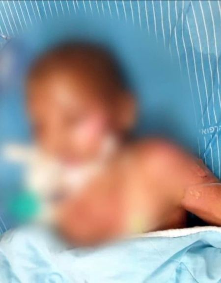حالته خطيرة : تدهور الحالة الصحية للطفل المصاب بحريق منزل في يافا