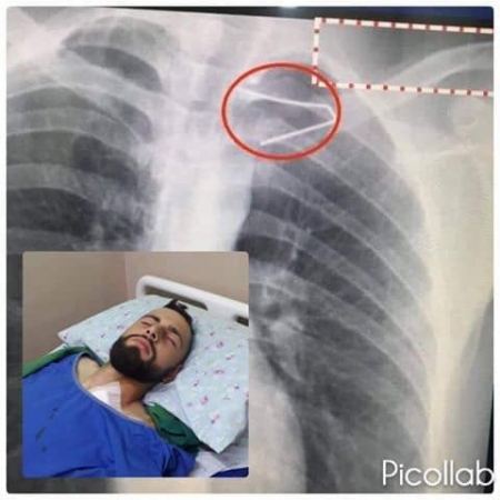 برطعة | ازالة مسمار دخل صدر شاب 