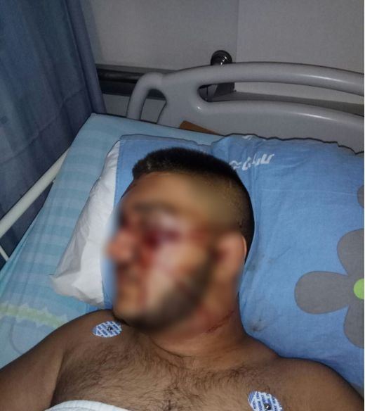 إصابة شاب من ام الفحم في وجهه اثر انفجار العاب نارية
