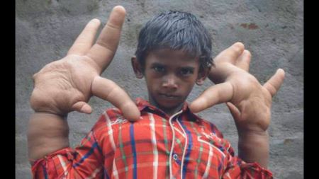 طفل هندي ذو كف اكبر من رأسه