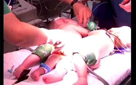 فيديو : فصل توأمان ملتصقان في الصين