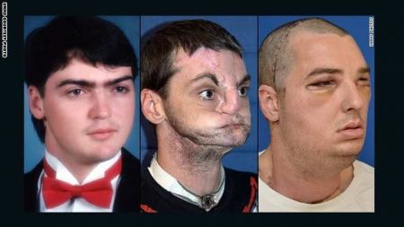 عملية جراحية رائدة لزراعة وجه في ميرلاند الامريكية