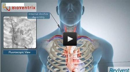 جديد في الجراحة : عمليات القلب دون شق الصدر