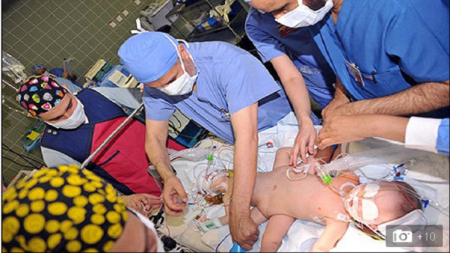 9 ساعات عملية فصل توأمين يمنيين في السعودية تكللت بالنجاح